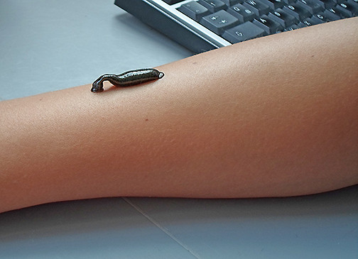 Egel auf dem Arm Ein Blutegel, der sich am Arm zur Blutegeltherapie festsaugt.