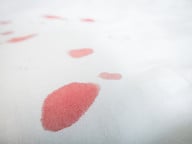 Composite of blood stains on white cotton fabric. Spüle Blutflecken vor dem Entfernen mit kaltem Wasser aus..