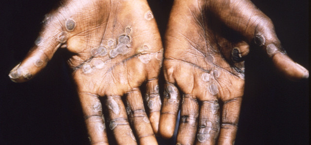 Dieses Bild aus dem Jahr 1997 entstand während einer Untersuchung eines Affenpockenausbruchs in der Demokratischen Republik Kongo (DRC), dem früheren Zaire, und zeigt die Handflächen eines Affenpockenpatienten aus Lodja, einer Stadt im Katako- Kombe Health Zone, der Demokratischen Republik Kongo.