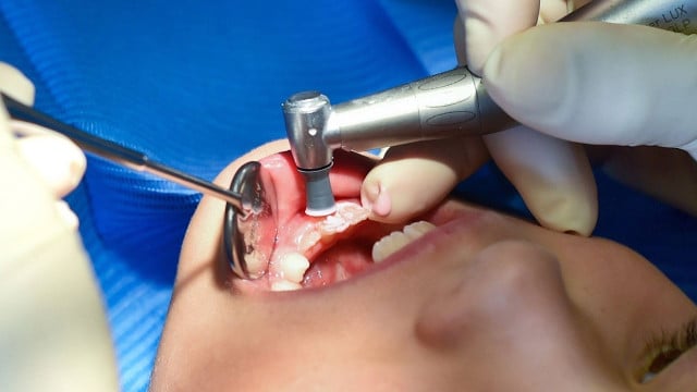 kreidezaehne-dpa Das Rätsel um die Kreidezähne