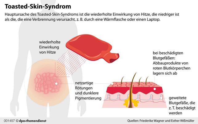 Gitterförmige Verfärbungen der Haut: Wer die an sich beobachtet, ist wahrscheinlich vom Toasted-Skin-Syndrom betroffen. Toasted-Skin-Syndrom: Wie es die Haut schädigt