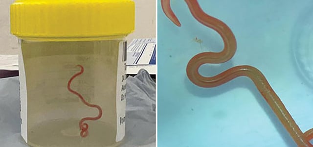 Live worm found in woman's brain