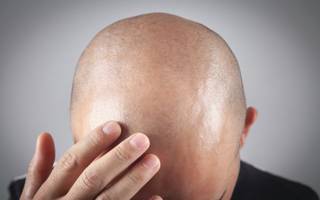 Caucasian bald man. Before hair transplantation Eine Glatze muss regelmäßig gepflegt werden.