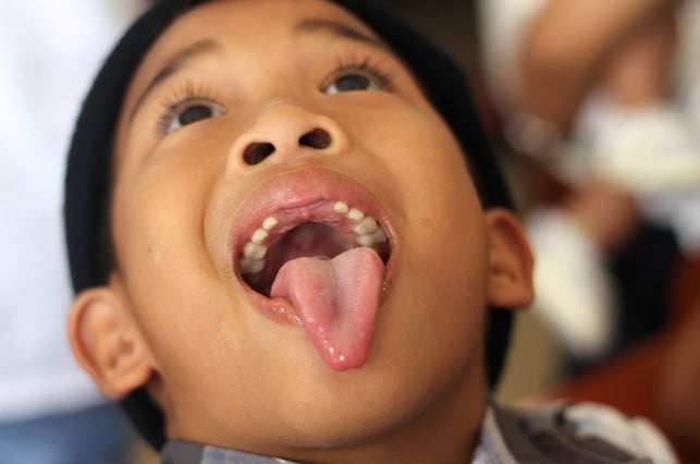 Tonsil stones are particularly common in children and adolescents.