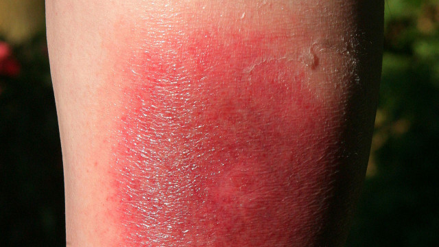 A clear warning sign of Lyme disease: The so-called traveling redness can appear days or weeks after a tick bite.