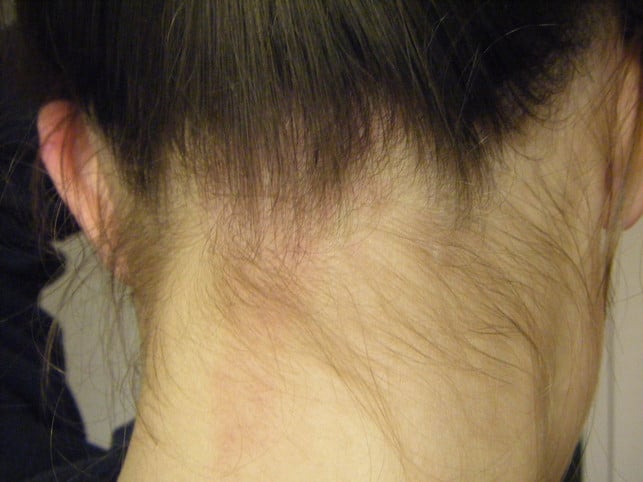 ein-kaum-noch-sichtbarer-storchenbiss-im-nacken-ei-cc0-commonswikimedia-teresahatfield-181012_download Ein kaum noch sichtbarer Storchenbiss im Nacken einer erwachsenen Frau.