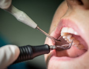 Wie sinnvoll ist eine Zahnzusatzversicherung?