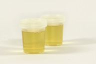 The iodine content is measured in the urine.