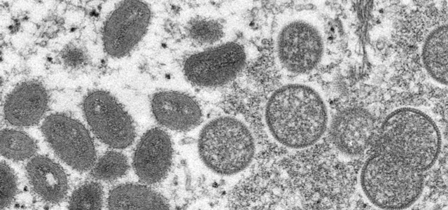 Diese elektronenmikroskopische Aufnahme aus dem Jahr 2003, die von den Centers for Disease Control and Prevention zur Verfügung gestellt wurde, zeigt reife, ovale Affenpockenviren (l) und kugelförmige unreife Virionen (r).