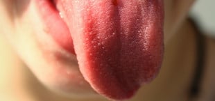 Belegte Zunge