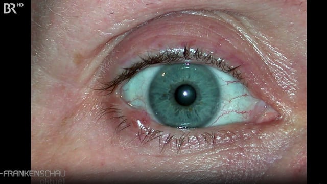 Basalioma on the eyelid