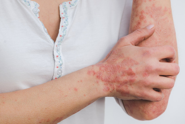ein-symptom-von-schuppenflechte-koennen-gelbe-fussnae-cc0-pixabay-miller_eszter-230128_download Ein Symptom von Schuppenflechte können gelbe Fußnägel sein.